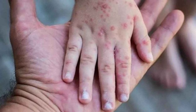 Maymun Çiçeği salgınının merkezi Kongo'da acil durum devam ediyor