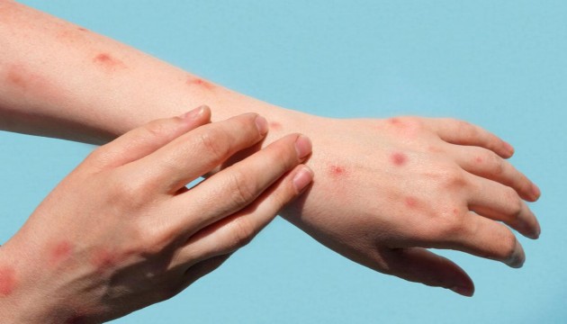 Maymun çiçeği virüsü Avrupa'ya sıçradı: İlk vaka doğrulandı